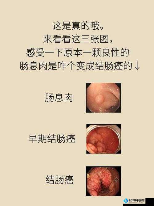 肛门息肉：一种肛肠疾病