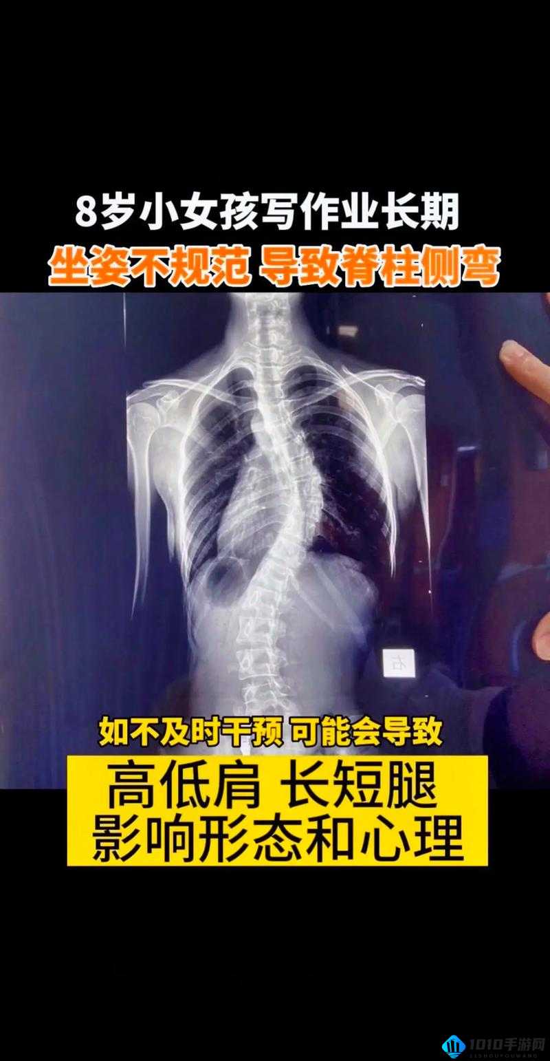 累弯腰弓背：长时间保持不良姿势